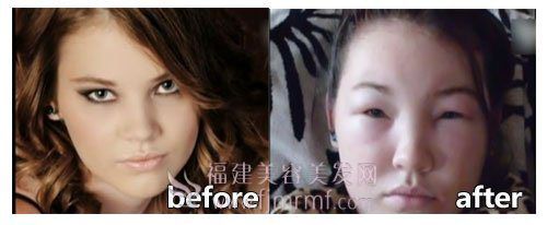 少女染发过敏前(qián)后对比 少女染发过(guò)敏前后对(duì)比